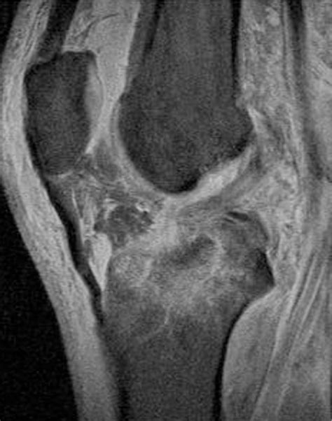 Figure 3 From Mri Classification Of Tibial Plateau Fractures Semantic