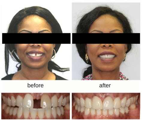 Gapped Teeth Before And After Braces Atilacollege