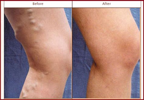 Pin On Varicose Veins Treatment Removal