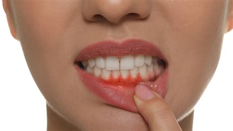 Can Gums Grow Back Around Teeth