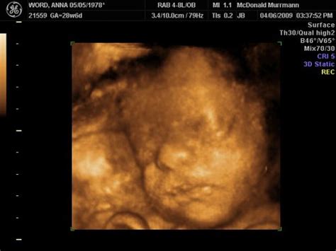 Fda Warns Against Keepsake Ultrasounds Parenting Patch
