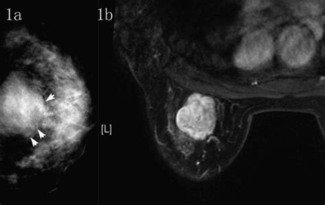 Imaging Findings In Phyllodes Tumors Of The Breast European Journal