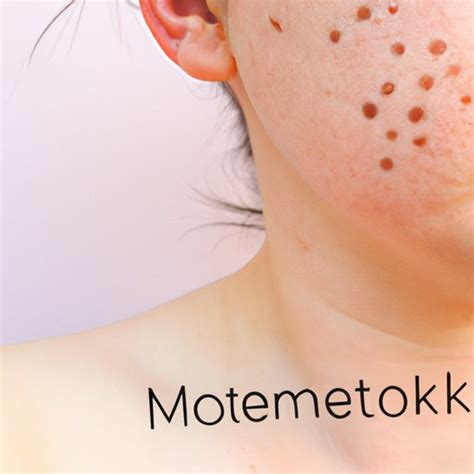 What Is Mottling Of The Skin Causes Symptoms And Treatment The