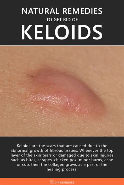 How To Get Rid Of Acne Keloids Howotre