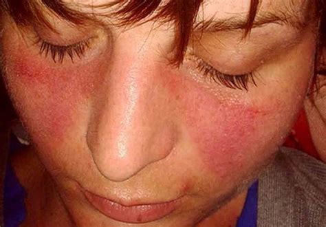 Lupus Symptoms Warning Signs And Symptoms Of Lupus Page Of
