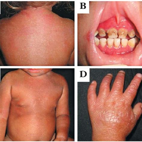 Erythematous Scaly Lesions On Sun Exposed Areas Hyperpigmentation