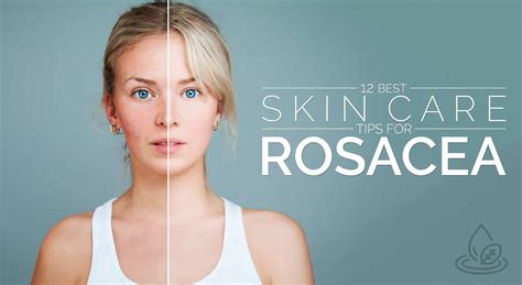 12 Best Skin Care Tips For Rosacea Positive Health Wellness