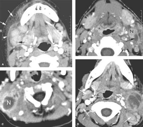 Cervical Adenopathy Reactive And Infectious Radiology Key