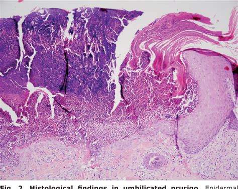 Figure 2 From Acquired Reactive Perforating Dermatosis Is A Variant Of