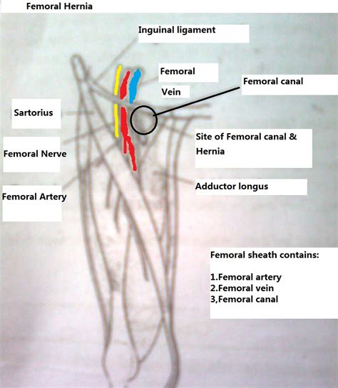 This is because of the wider shape of the female pelvis. FEMORAL CANAL HERNIA images galleries - healthgalleries.com