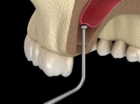 Bone Grafting Sinus Lift Appledore Dental And Implant Centre