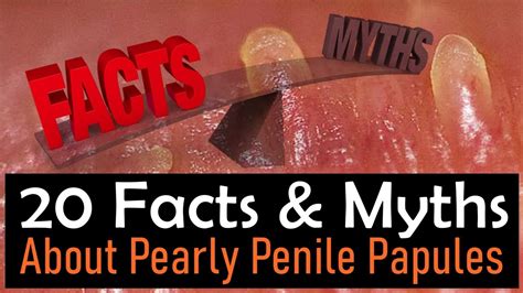 Pearly Penile Papules Facts And Myths 20 Facts And Myths About Pearly