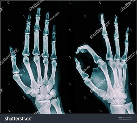 Stock Photo Film X Ray Hand Ap Oblique View Show Human S Hand 614514542