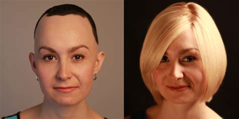 Alopecia And Wigs For Hair Loss Custom Hair