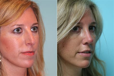 Rhinoplasty Photos Chevy Chase Md Patient 19490