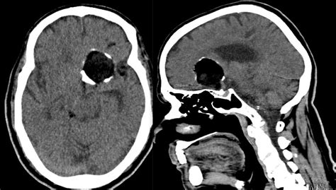 Intracranial Dermoid Cyst Occur As A Developmental Anomaly In Which