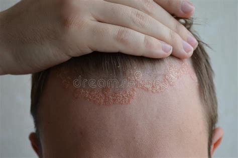 Psoriasis On The Skin Close Up Scalp Photos Of Dermatitis And Eczema