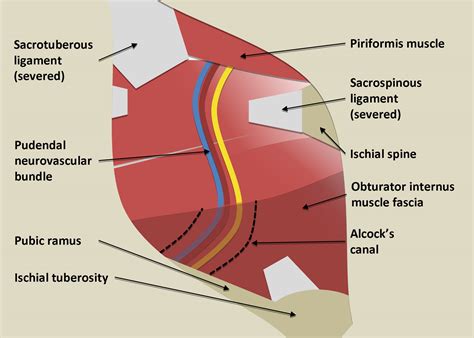 Repeat Operation For Treatment Of Persistent Pudendal Nerve Entrapment