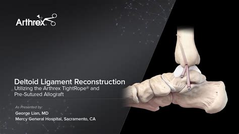 Arthrex Deltoid Ligament Reconstruction Utilizing The Arthrex My Xxx