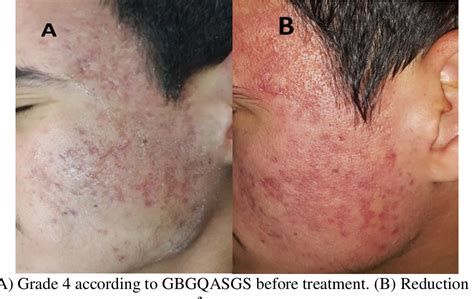 Figure 2 From Rejuvenation Of Severe Acne Scars By Microneedling