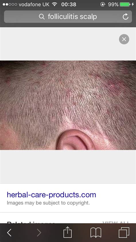 The Best 5 Infected Hair Follicle Pictures On Scalp Gastroagesz