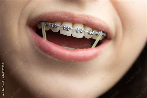 Closeup Of A Woman With Braces Wearing Power Chains And Orthodontic