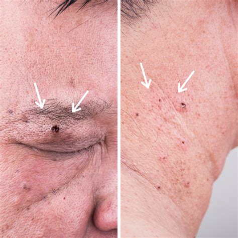 Cosmetic Mole And Benign Skin Lesion Removal Ultimate Aesthetics