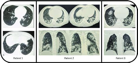 High Resolution Ct Scan Of All Three Patients Download Scientific