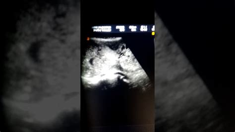 Twin Pregnancy With Chmf Complete Hydatidiform Mole Coexisting With A