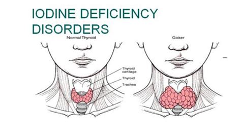A deficiency of iodine can create a hormonal imbalance due to poor thyroid functioning. Iodine deficiency in Pakistan — truth and rumours - Daily ...