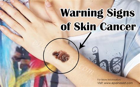 7 Skin Cancer Warning Signs You Should Never Ignore River Oaks Beauty