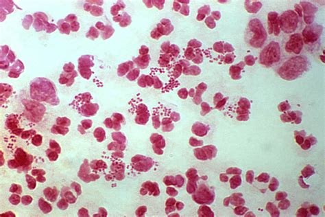 Neisseria gonorrhoeae входят в семейство neisseriaceae, род neisseria. Foto gratis: grammo, uretrale, essudato, campione, di ...