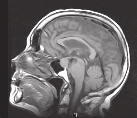 a sagittal head mri showing compressed pituitary contents small my xxx hot girl