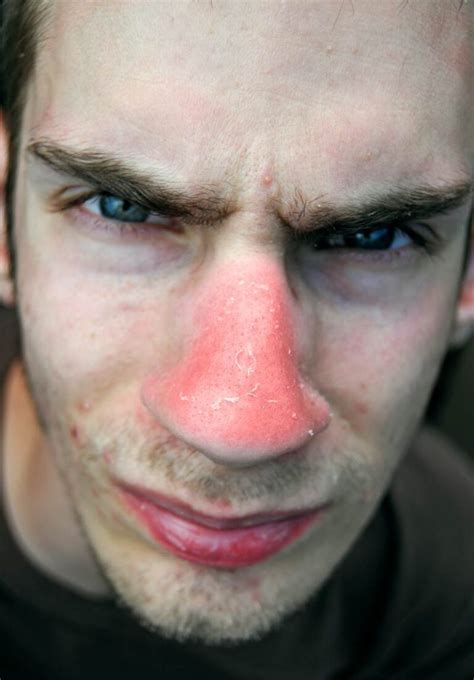 Nose Sunburn Signs Blistered Treatments And Home Remedies American