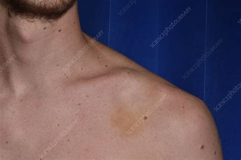 Collar Bone Fracture Stock Image C0473027 Science Photo Library