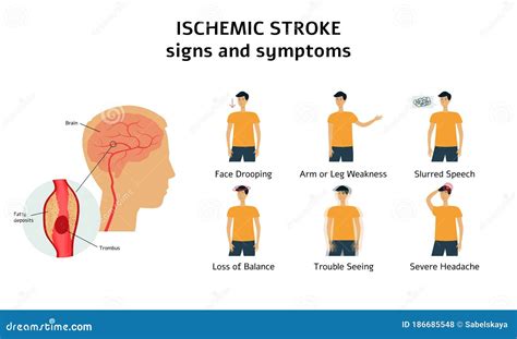 Ischemic Stroke Signs And Symptoms Infographic Flat Vector Illustration My Xxx Hot Girl