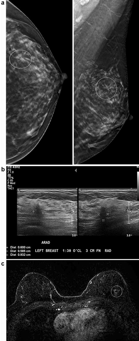 A Screening Mammogram Detected Left Breast Architectural Distortion In