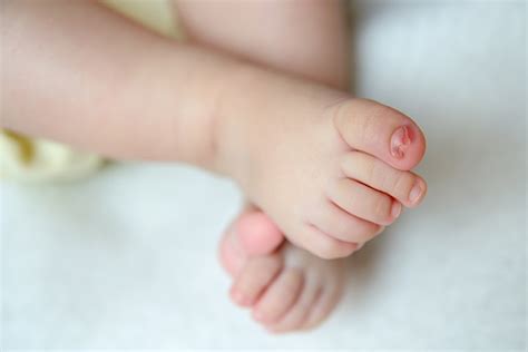 Uñas De Los Pies Encarnadas Del Bebé Causas Tratamiento Y Prevención