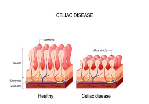 How I Put Celiac Disease Into Remission And Healed My Body
