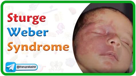 Sturge Weber Syndrome Genetics Clinical Manifestations Diagnosis