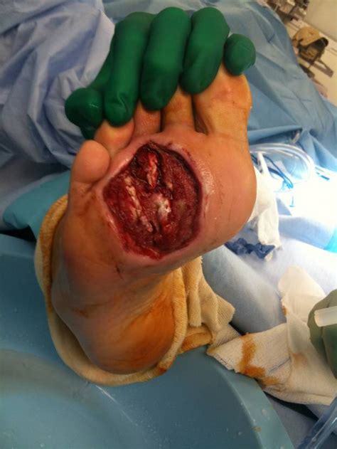 Squamous Cell Carcinoma Of The Foot A Case Report The