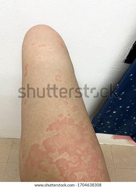 Picture Erythematous Rash Itch On Human Stock Photo 1704638308