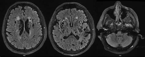 État Criblé An Incidental Finding On Ct Brain In Acute Covid 19 Bmj