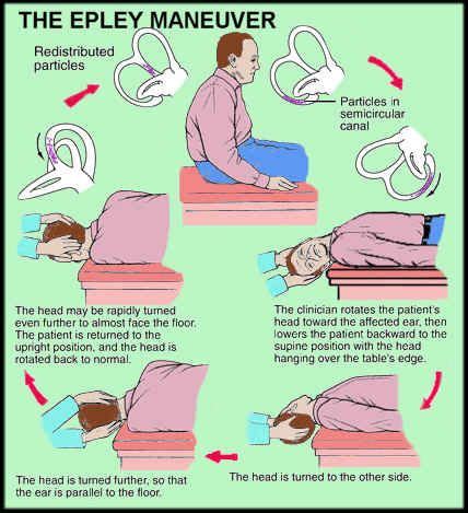 The epley maneuver or repositioning maneuver is a maneuver used by medical professionals to treat one common cause of vertigo, benign paroxysmal positional vertigo (bppv) of the posterior or anterior canals of the ear. Benign Paroxysmal Positional Vertigo (BPPV) | Vertigo ...