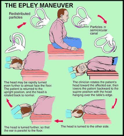 The home epley maneuver is similar. Benign Paroxysmal Positional Vertigo (BPPV) | Epley ...