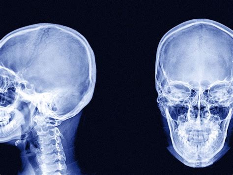 Bone Cancer On The Skull Symptoms And More