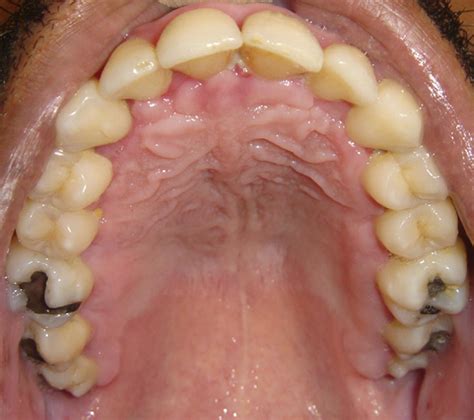 Median Palatal Cyst Case Report And Review Of Literature Journal Of