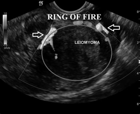 A Uterine Transvaginal Ultrasound Section Evidenced The Open I