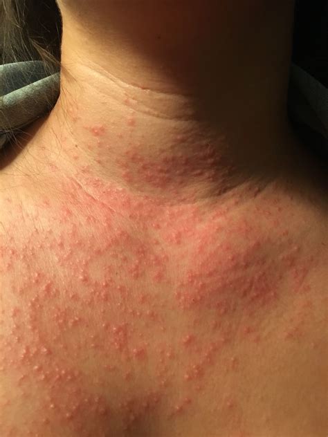 Pruritic Rash On Neck And Chest