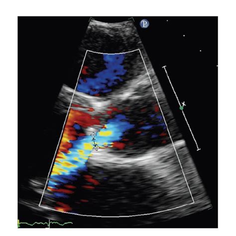 Color Doppler Evaluation Of The Aortic Valve Regurgitation The Arrow